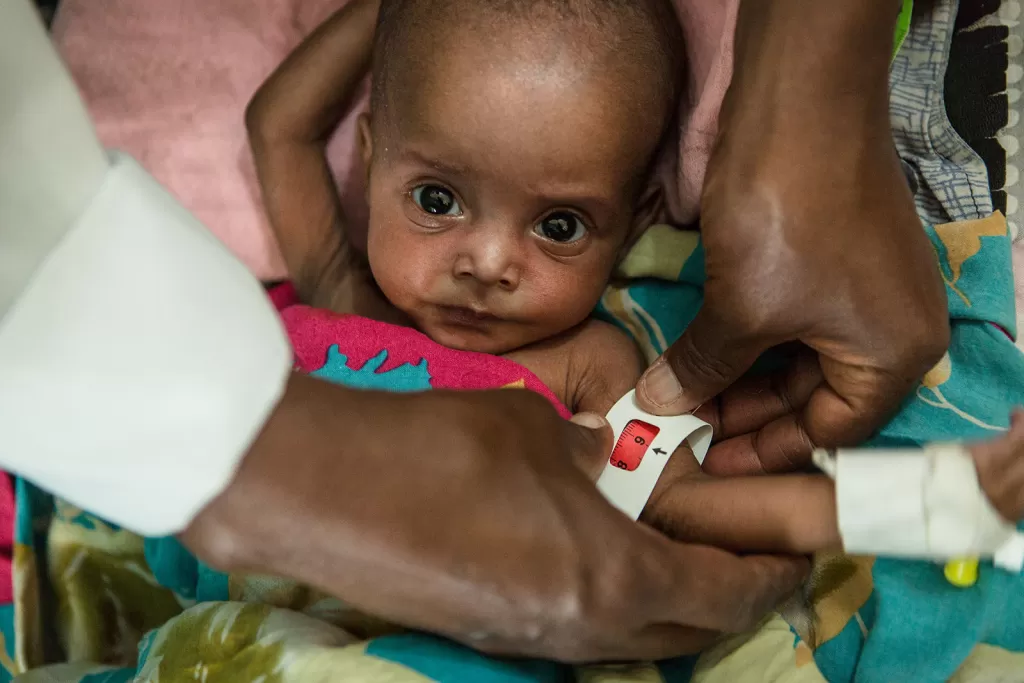 A malnourished child has their arm measured